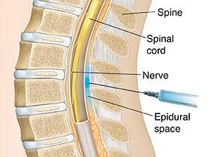 BIẾN CHỨNG THẦN KINH NGHIÊM TRỌNG CỦA GÂY TÊ TRỤC THẦN KINH TRUNG ƯƠNG TRONG SẢN KHOA