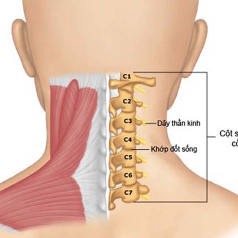 GÂY MÊ CHO PHẪU THUẬT CỘT SỐNG CỔ