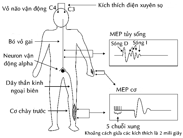 TỔN THƯƠNG TỦY TRONG PHẪU THUẬT CỘT SỐNG