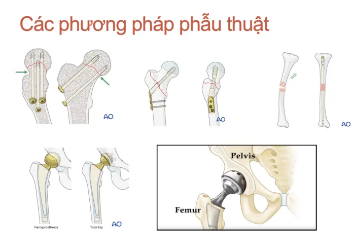 LỰA CHỌN Gây tê tuỷ sống hoẶc gây mê cho phẫu thuật gãy khớp háng