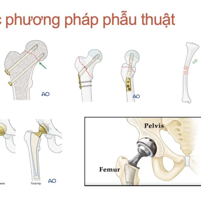 LỰA CHỌN Gây tê tuỷ sống hoẶc gây mê cho phẫu thuật gãy khớp háng